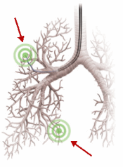 resp-nódulo pulmonar