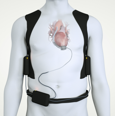 Ilustración del dispositivo de asistencia ventricular izquierda